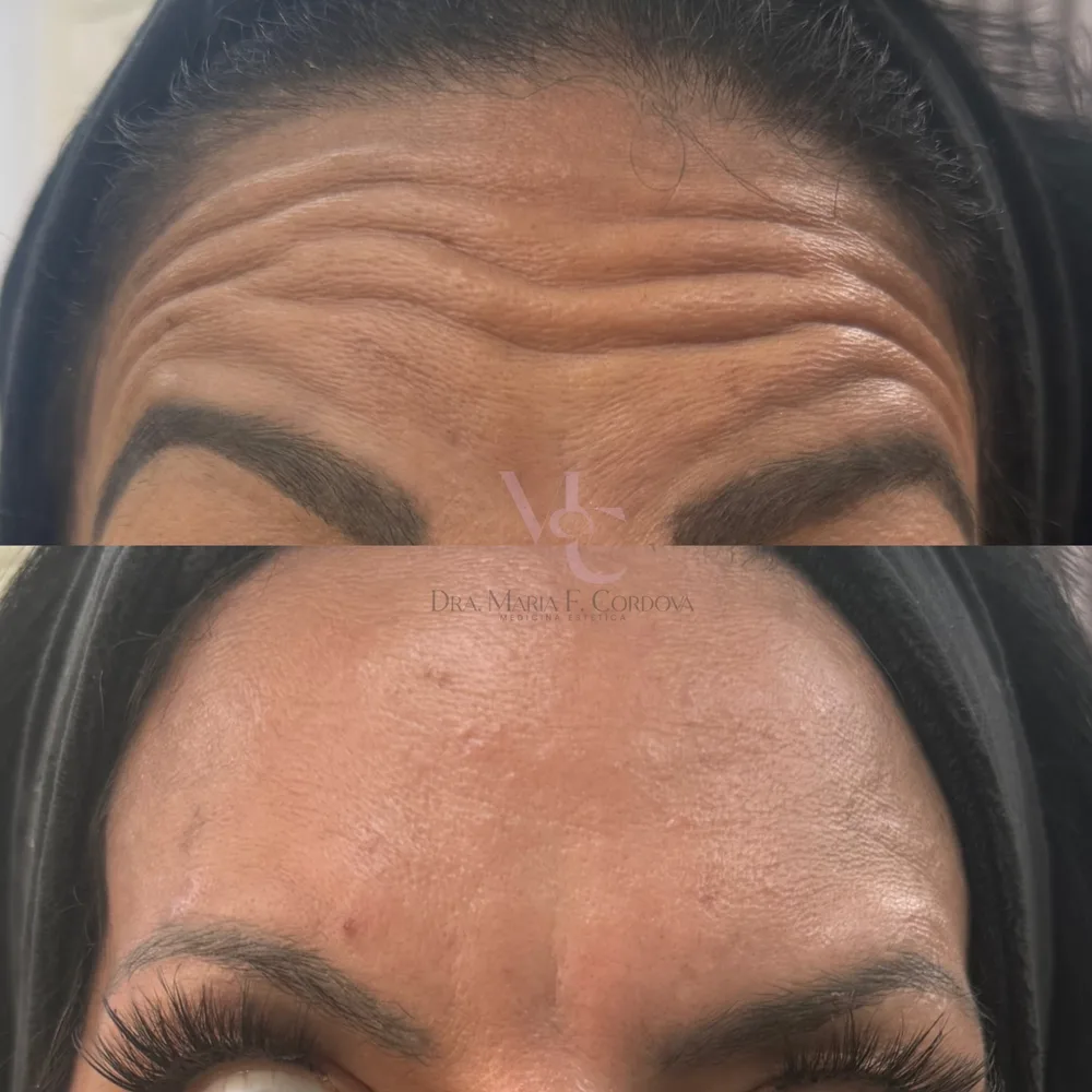 Antes y después de Botox en frente