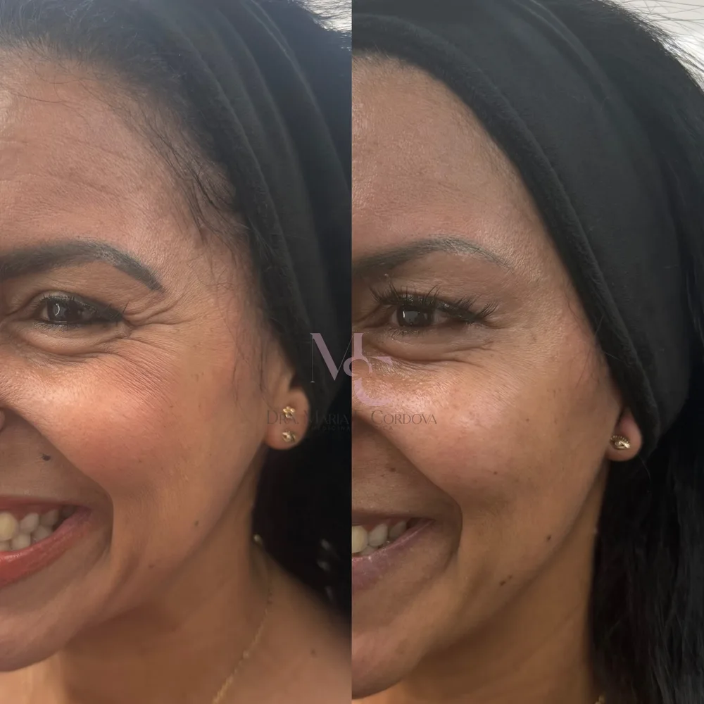 Antes y después de Botox en contorno de ojos